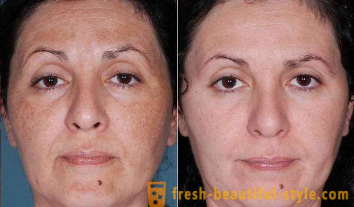 Exfoliaciones con ácido para la cara: opiniones, fotos antes y después
