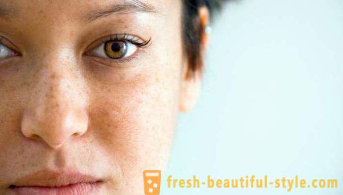 Manchas marrones en la cara: las causas y los tratamientos. Las manchas marrones