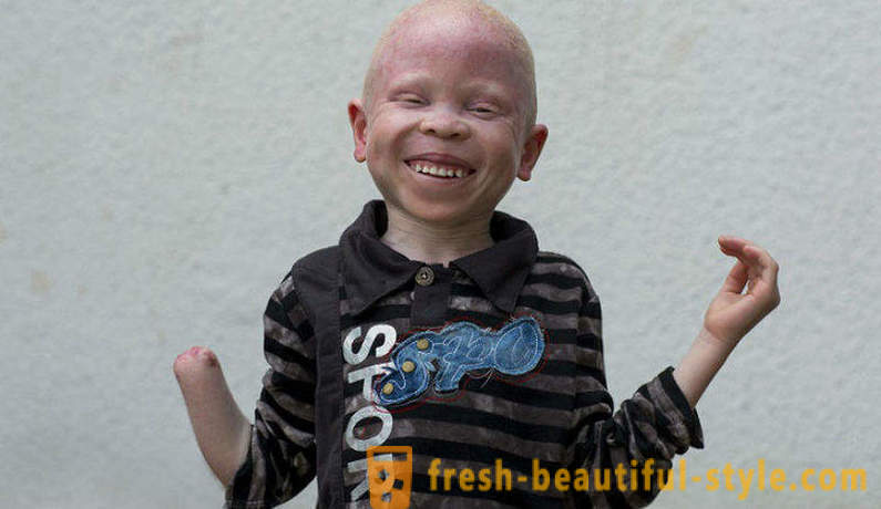 La trágica historia de Tanzania los albinos