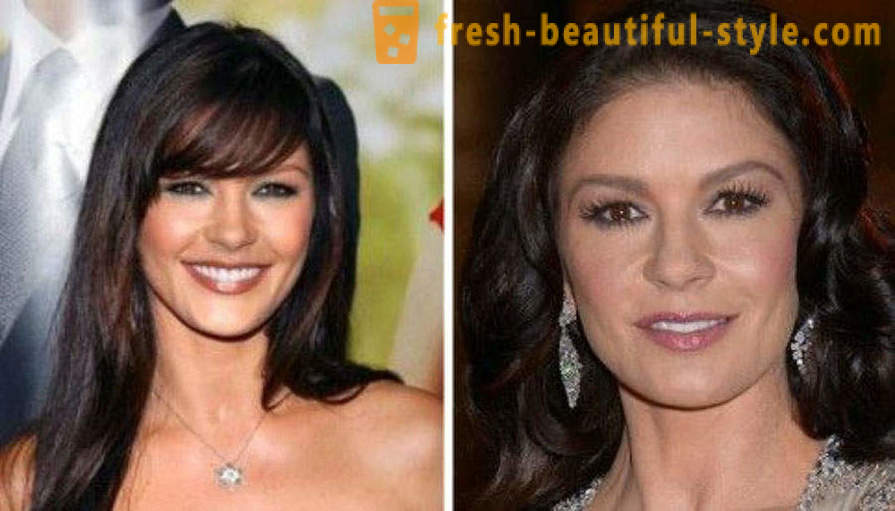 15 celebridades, terminaron mal con Botox