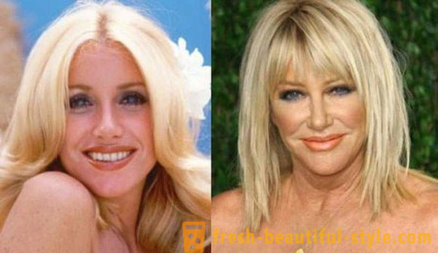 15 celebridades, terminaron mal con Botox