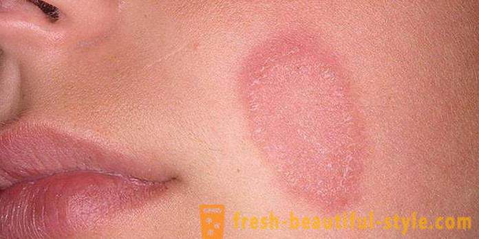 Escamas en la piel de la cara y las manos: posibles causas y características de la atención