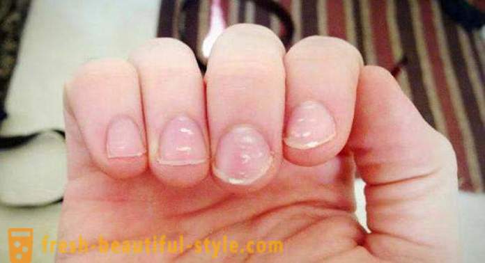 Las manchas blancas en las uñas de los dedos: las causas y el tratamiento