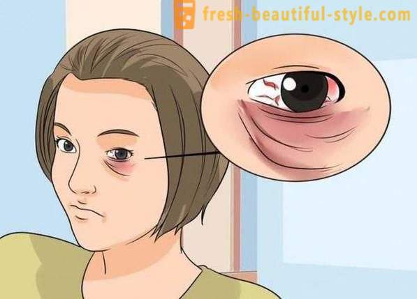 Cómo ocultar un ojo negro de un golpe: cosméticos, especialmente las recomendaciones y