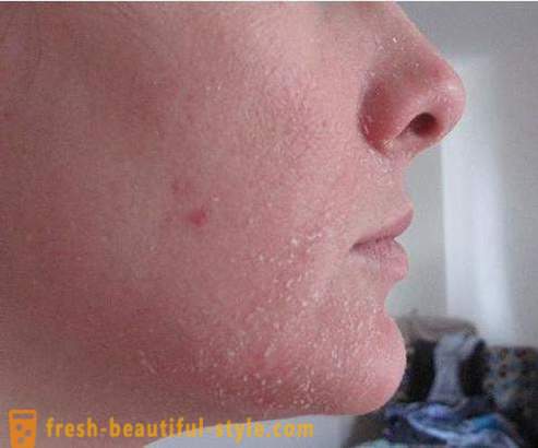 ¿Por qué la piel escamosa en la cara? Problema piel facial