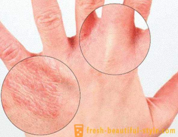 La piel seca de las manos: Causas. Muy piel seca, ¿qué hacer?