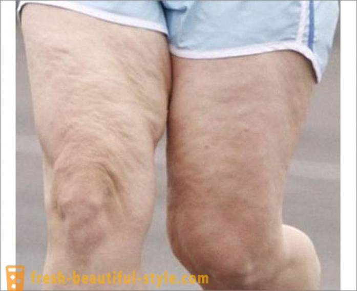 ¿Cómo deshacerse de la celulitis en las piernas? Ejercicios para las piernas de la celulitis