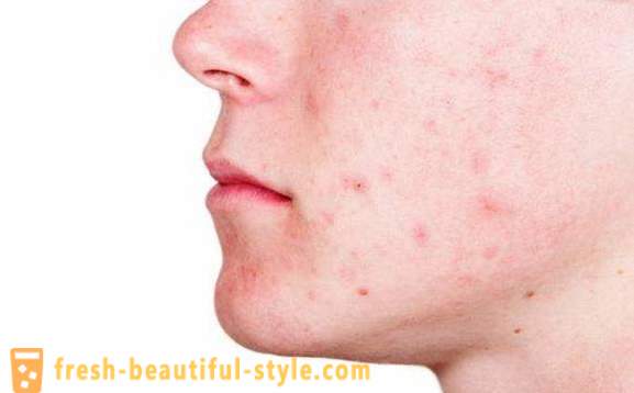 Deshacerse de acné y rastros de ellos. ¿Cómo deshacerse de acné en diferentes áreas de la piel