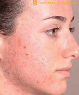 ¿Cómo deshacerse de las huellas después de acné y restaurar la piel bonita vista?