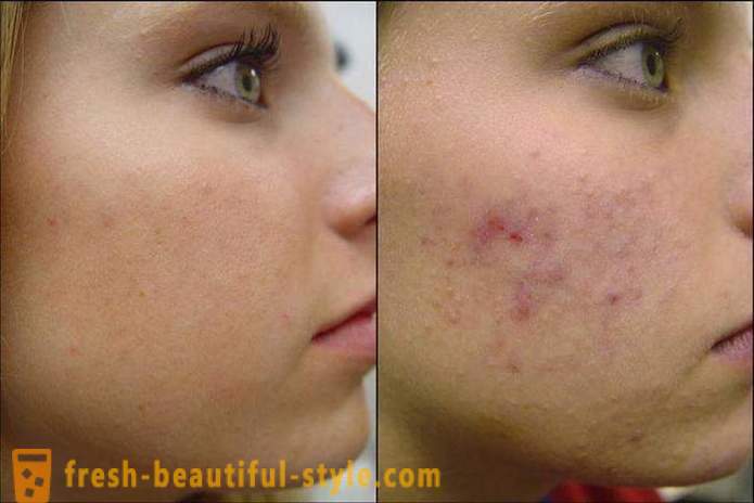 Cómo limpiar la cara del acné por lo que ya no regresaron